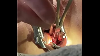 Holding cervix w tenaculum while 8mm dilator fucks uterus